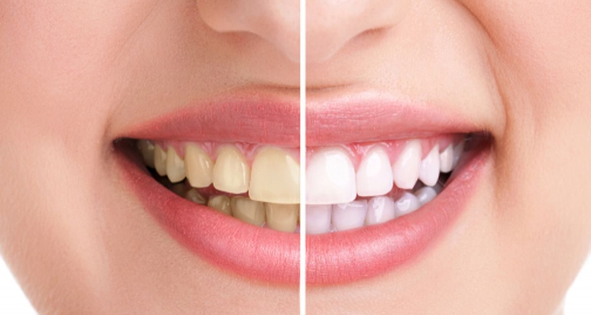Cara Merawat Gigi Agar Tetap Sehat Dan Putih