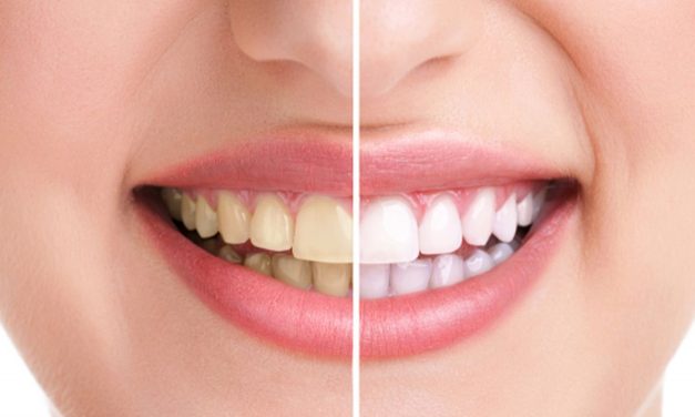 Cara Merawat Gigi Agar Tetap Sehat Dan Putih
