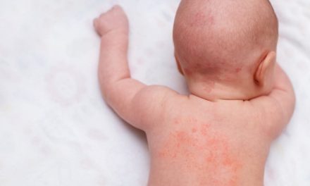 Kulit Bayi Mudah Iritasi: Kebiasaan Perawatan Yang Diperhatikan